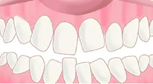 アクトレス矯正before