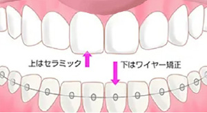 アクトレス矯正after