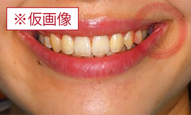 アクトレス矯正after