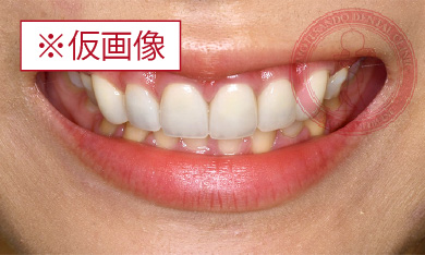 アクトレス矯正after