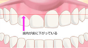 バランス歯肉整形before