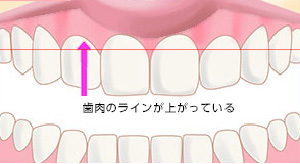 バランス歯肉整形after