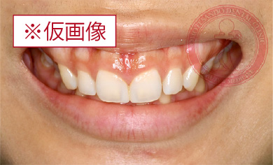 バランス歯肉整形before