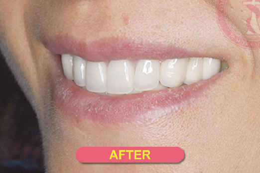 きれいにそろった歯の画像