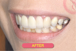 高級スマイルライン治療症例