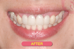 スマイルライン治療症例