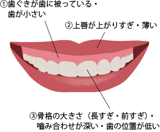 ①歯ぐきが歯に被っている・歯が小さい②上唇が上がりすぎ・薄い③骨格の大きさ（長すぎ・前すぎ）・嚙み合わせが深い・歯の位置が低い