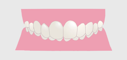 過蓋咬合の歯