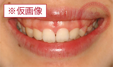 歯肉整形before