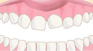 ワイヤー矯正before